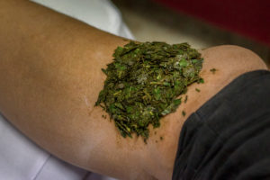 poultice for healing burns