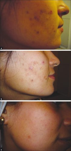 Girll before and after red light therapy treatment for acne vulgaris.