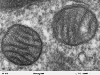 mitochondria in tumors are damaged or injured