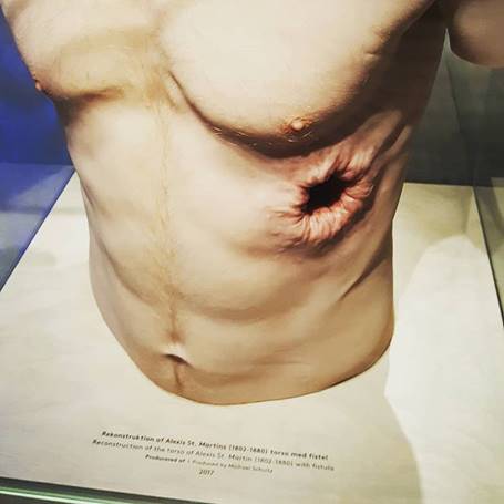 Alexis St. Martin's torso reconstruction sculpture raw meat study