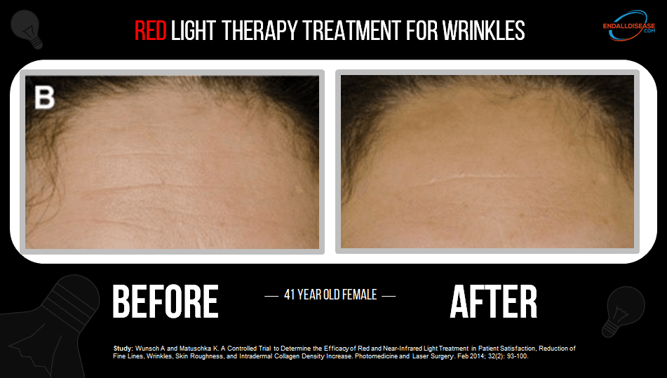 red light therapy for wrinkles before and after pictures
