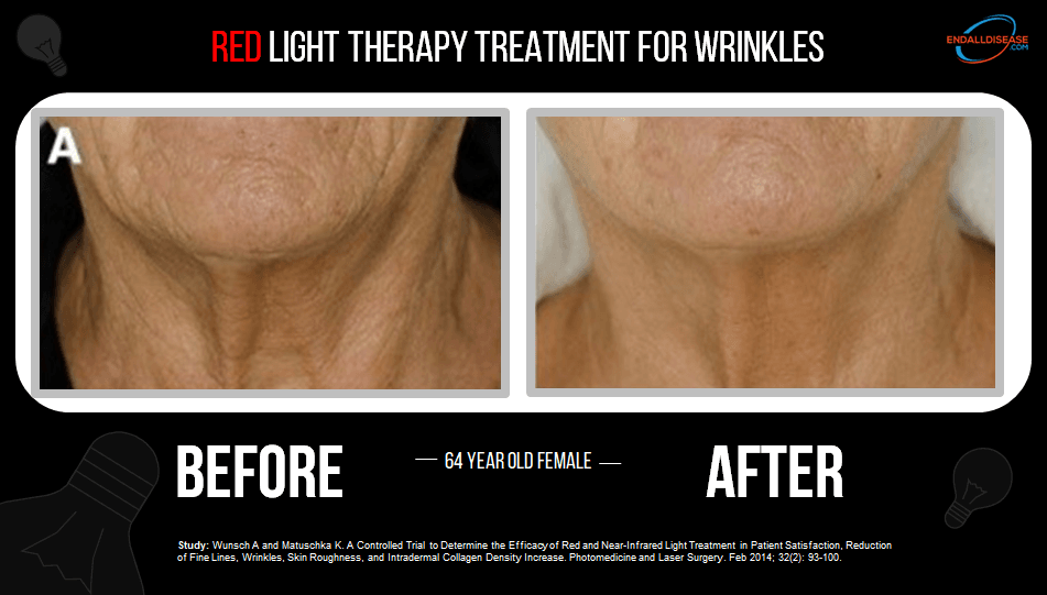 Fine lines and wrinkles visibly reduced with red light therapy