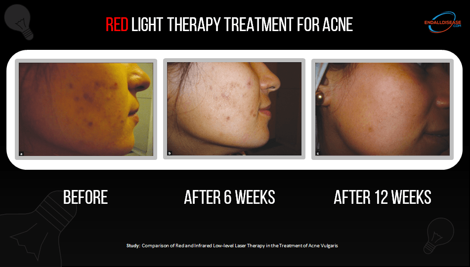red light therapy for acne before and after